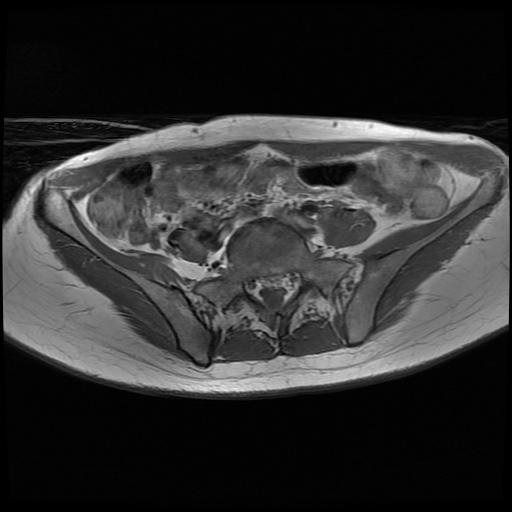 File:Normal female pelvis MRI (retroverted uterus) (Radiopaedia 61832-69933 Axial T1 6).jpg