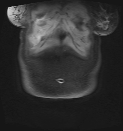 File:Normal hepatobiliary phase liver MRI (Radiopaedia 58968-66230 B 51).jpg