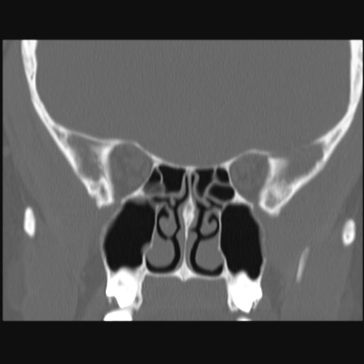 Normal sinus CT (annotated) (Radiopaedia 78917-91810 Coronal bone window 35).jpg