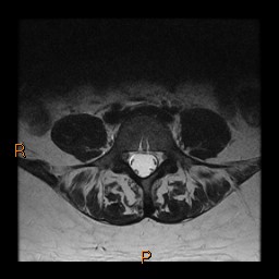 File:Normal spine MRI (Radiopaedia 77323-89408 Axial T2 19).jpg