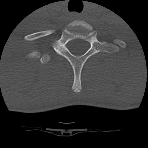 File:Normal trauma spine imaging (age 16) (Radiopaedia 45335-49358 Axial bone window 69).jpg