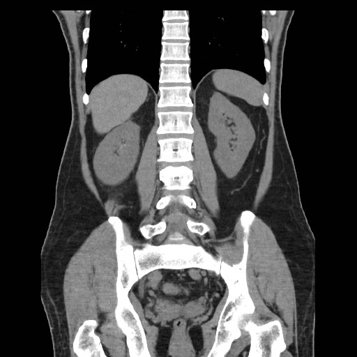 File:Obstructed kidney with perinephric urinoma (Radiopaedia 26889-27067 Coronal non-contrast 20).jpg