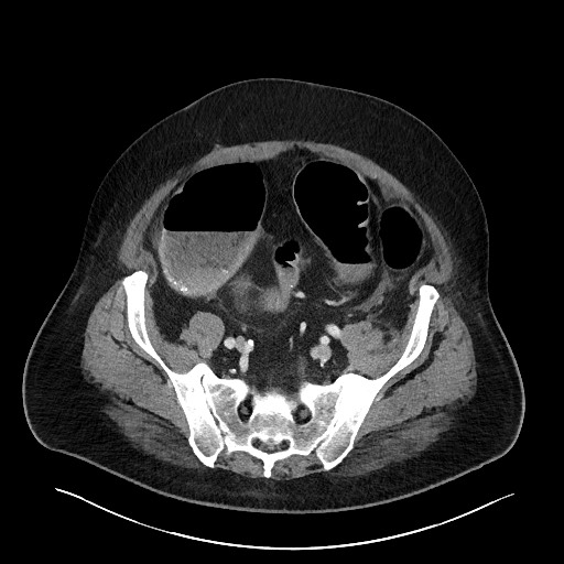 Obstructing sigmoid adenocarcinoma (Radiopaedia 58465-65619 A 125).jpg