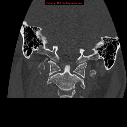 File:Occipital condyle fracture (Radiopaedia 18366-18208 Coronal bone window 11).jpg