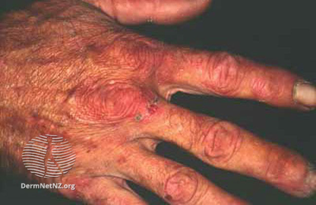 File:Porphyria cutanea tarda (DermNet NZ systemic-pct7).jpg