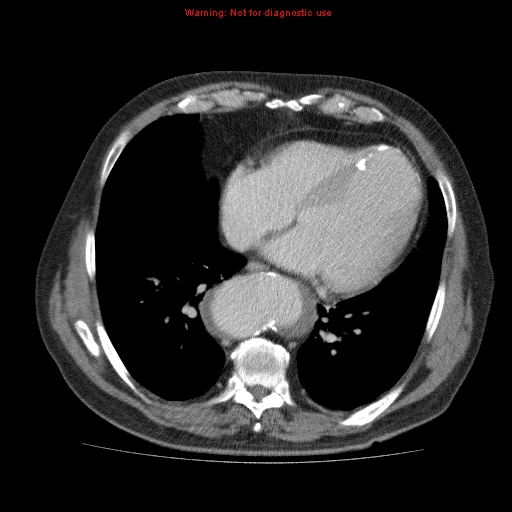 Abdominal aortic aneurysm (Radiopaedia 10122-10660 Axial C+ portal venous phase 1).jpg