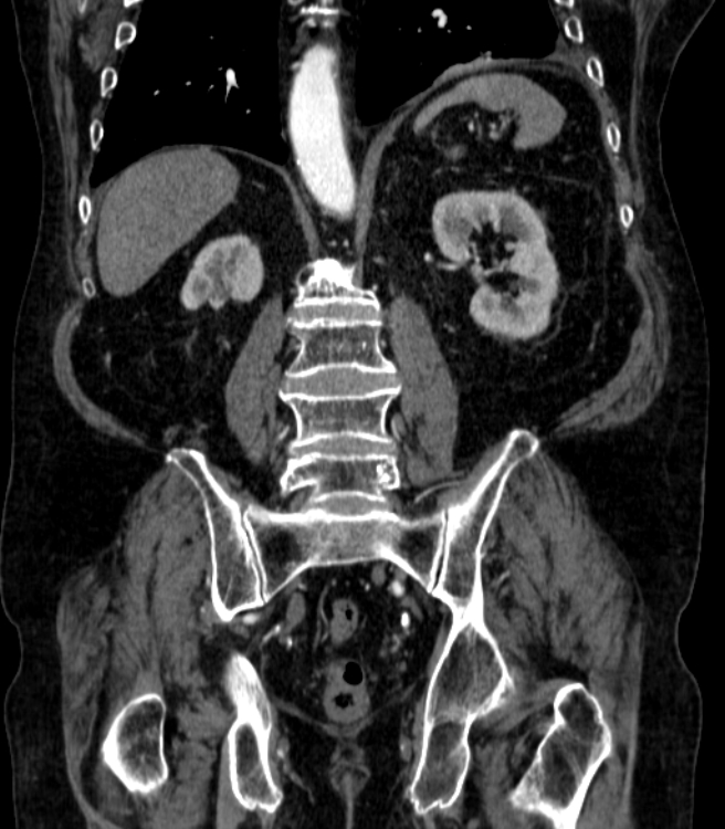 Abdominal aortic aneurysm (Radiopaedia 25855-26001 Coronal C+ arterial phase 52).jpg
