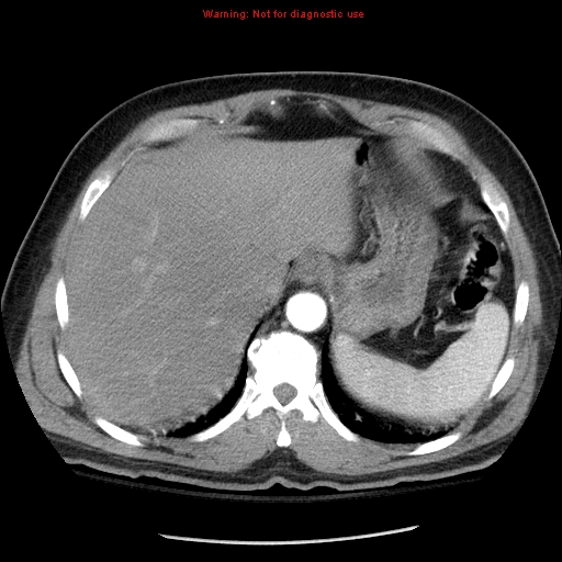 Abdominal aortic aneurysm (Radiopaedia 8190-9038 Axial C+ arterial phase 13).jpg