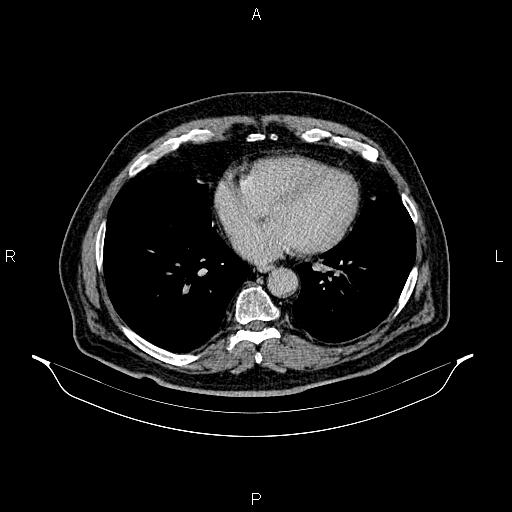Abdominal aortic aneurysm (Radiopaedia 83094-97462 Axial renal excretory phase 3).jpg