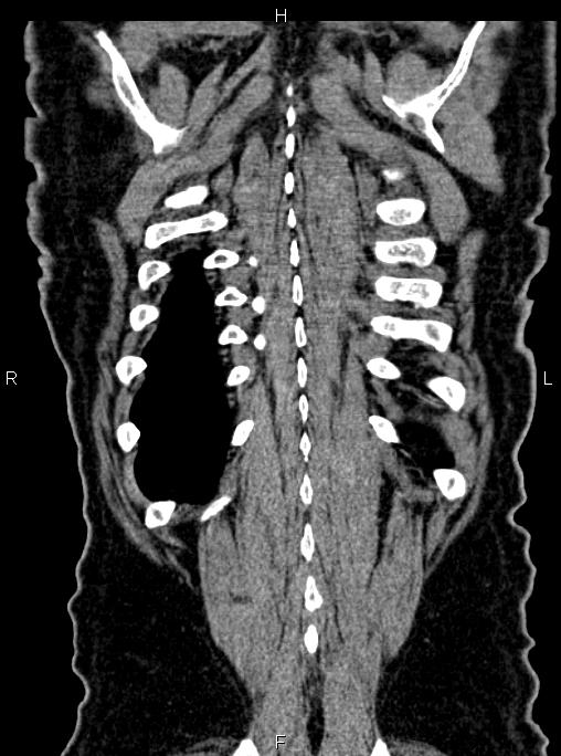 Abdominal aortic aneurysm (Radiopaedia 83094-97462 Coronal renal cortical phase 83).jpg