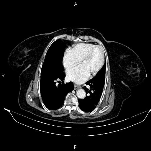 File:Abdominal aortic aneurysm (Radiopaedia 85063-100606 Axial C+ portal venous phase 22).jpg