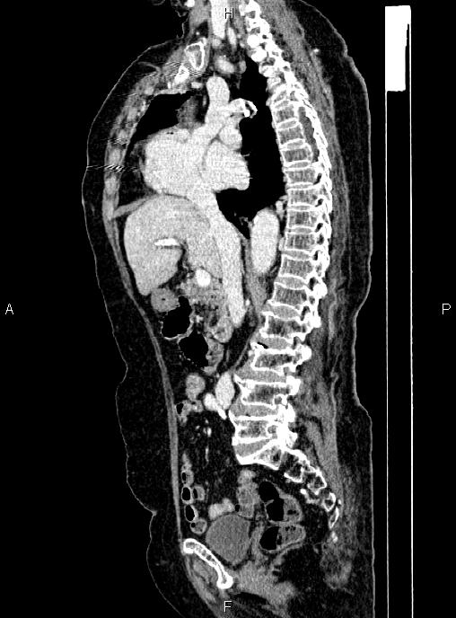 Abdominal aortic aneurysm (Radiopaedia 85063-100606 Sagittal C+ arterial phase 35).jpg