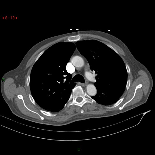 Abdominal aortic aneurysm rupture with aortocaval fistula (Radiopaedia 14897-14841 Axial C+ arterial phase 19).jpg