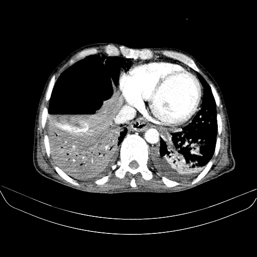 File:Abdominal collection due to previous cecal perforation (Radiopaedia 80831-94320 Axial C+ portal venous phase 13).jpg