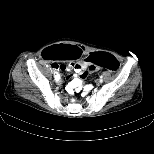 File:Abdominal collection due to previous cecal perforation (Radiopaedia 80831-94320 Axial C+ portal venous phase 168).jpg