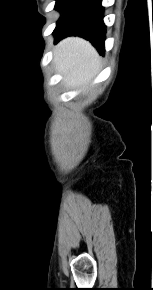 Abdominal wall and retroperitoneal tuberculosis (Radiopaedia 88137-104729 Sagittal C+ portal venous phase 138).jpg