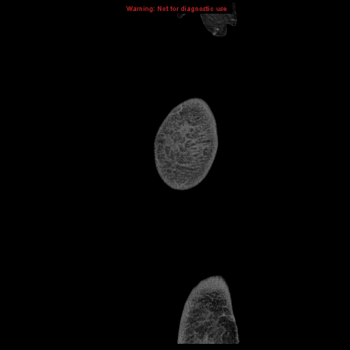 Abdominal wall hematoma (Radiopaedia 9427-10112 Sagittal C+ portal venous phase 115).jpg