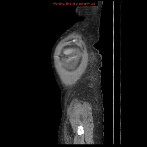 Abdominal wall hematoma (Radiopaedia 9427-10112 Sagittal C+ portal venous phase 9).jpg