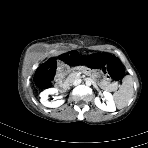 File:Abdominal wall hematoma with active bleeding (Radiopaedia 83915-99117 Axial C+ portal venous phase 19).jpg
