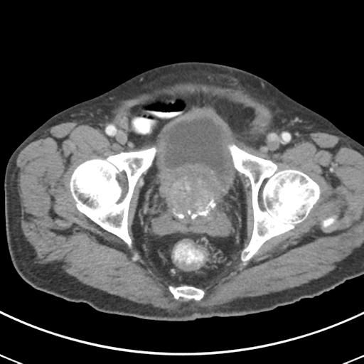Abdominal wall metastasis from colorectal carcinoma (Radiopaedia 31016-31717 Axial C+ portal venous phase 72).jpg