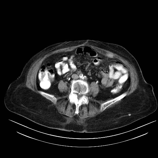 File:Abdominal wall recurrence after colorectal resection for cancer (Radiopaedia 23444-23523 Axial C+ portal venous phase 20).jpg