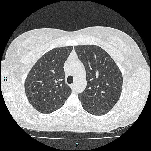 Accidental foreign body aspiration (seamstress needle) (Radiopaedia 77740-89983 Axial lung window 20).jpg