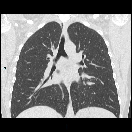 Accidental foreign body aspiration (seamstress needle) (Radiopaedia 77740-89983 Coronal lung window 28).jpg