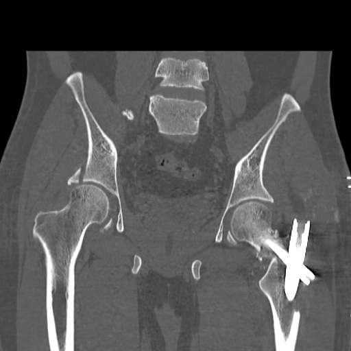 Acetabular and ilial fractures (Radiopaedia 59084-66378 Coronal bone window 30).jpg