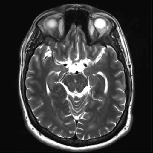 File:Achondroplasia (Radiopaedia 65109-74105 Axial T2 14).png