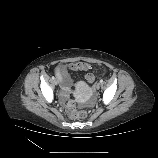 File:Acinar cell carcinoma of the pancreas (Radiopaedia 75442-86669 Axial C+ portal venous phase 126).jpg