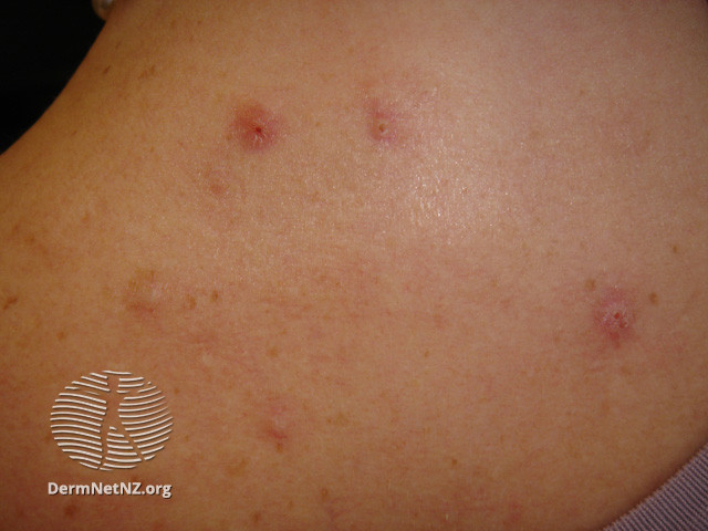 File:Acne affecting the back images (DermNet NZ acne-acne-back-157).jpg