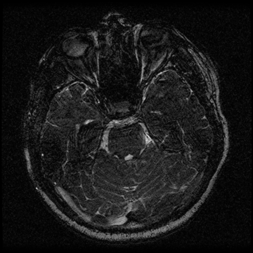 Acoustic schwannoma (Radiopaedia 33045-34060 Axial T2 62).png