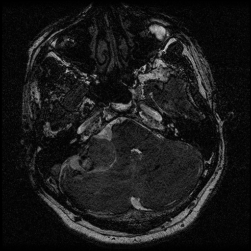 File:Acoustic schwannoma (Radiopaedia 39170-41387 Axial FIESTA 59).png