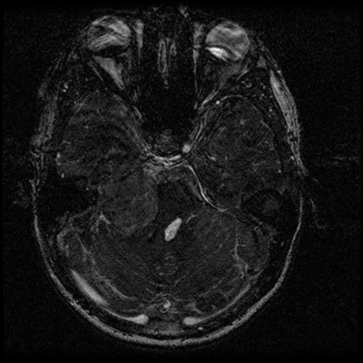 Acoustic schwannoma - eroding petrous apex (Radiopaedia 39674-42004 Axial T2 61).png