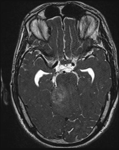 File:Acoustic schwannoma - probable (Radiopaedia 20386-20292 Axial T1 57).jpg