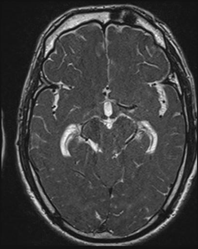 File:Acoustic schwannoma - probable (Radiopaedia 20386-20292 Axial T1 64).jpg