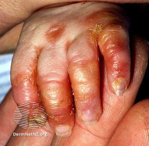 File:Acrodermatitis enteropathica (DermNet NZ systemic-acrhand).jpg
