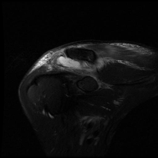 File:Acromioclavicular joint dislocation (Radiopaedia 14218-14076 Coronal PD fat sat 2).jpg