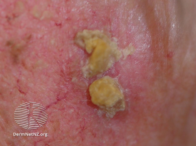 Actinic Keratoses affecting the face (DermNet NZ lesions-ak-face-344).jpg