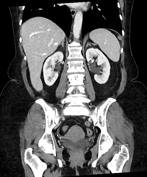Active Crohn disease (Radiopaedia 59394-66750 Coronal C+ portal venous phase 46).jpg
