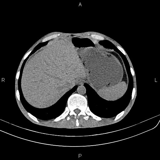 File:Active crohn disease (Radiopaedia 87133-103397 Axial non-contrast 14).jpg