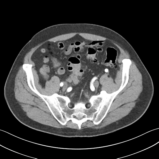 File:Active diverticular hemorrhage (Radiopaedia 39415-41725 Axial C+ arterial phase 51).png