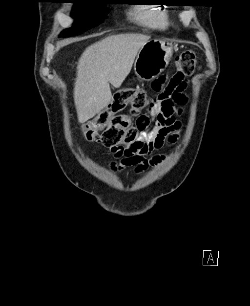 Active lower gastrointestinal bleeding - diverticular (Radiopaedia 61203-69106 Coronal C+ portal venous phase 21).jpg