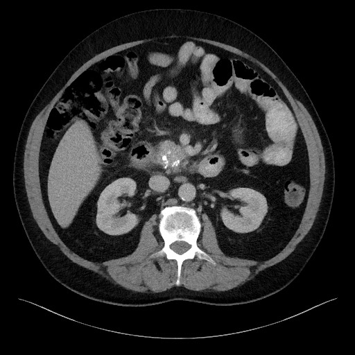 Acute-on-chronic pancreatitis (Radiopaedia 67286-76656 Axial C+ portal venous phase 34).jpg