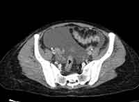 Acute Budd-Chiari syndrome (Radiopaedia 60858-68638 A 240).jpg