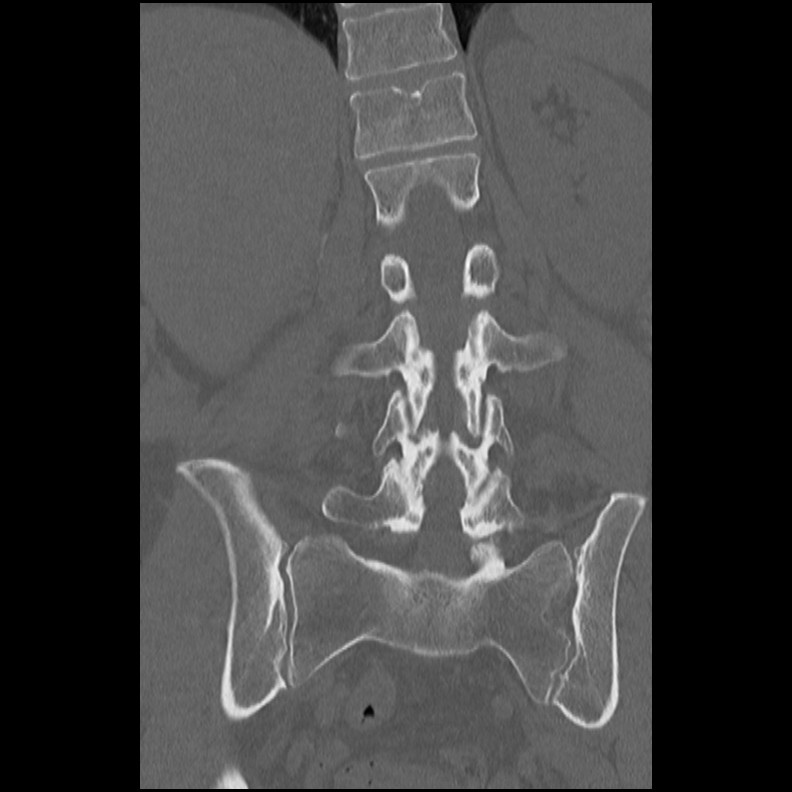 Acute Schmorl's node (Radiopaedia 83276-102365 Coronal bone window 34).jpg