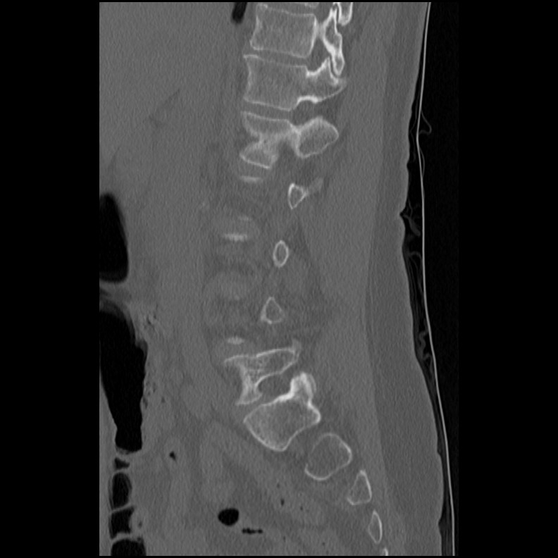 Acute Schmorl's node (Radiopaedia 83276-102365 Sagittal bone window 50).jpg