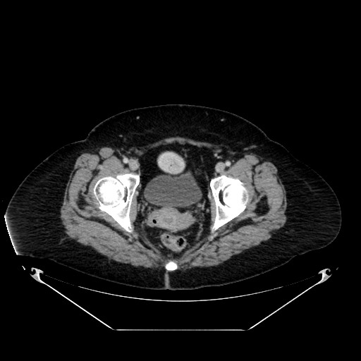 Acute appendicitis, heterotaxy syndrome (Radiopaedia 66884-76202 Axial C+ portal venous phase 121).jpg