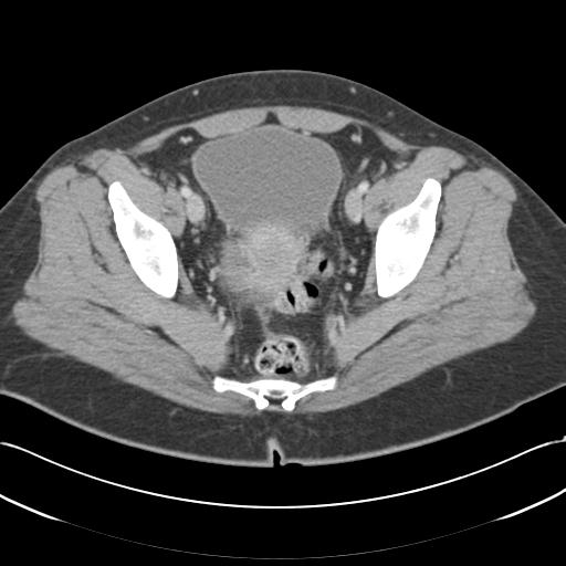Acute appendicitis (Radiopaedia 30297-30934 Axial C+ portal venous phase 71).jpg