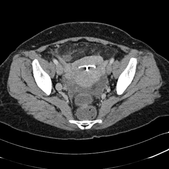 Acute appendicitis (Radiopaedia 48792-53822 Axial C+ portal venous phase 100).jpg